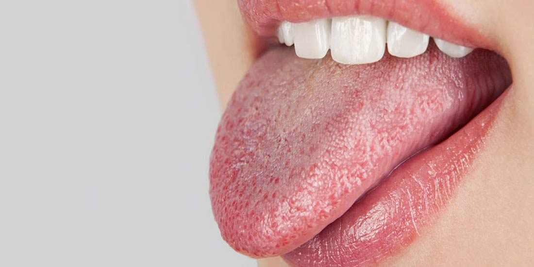 ¿Qué es la boca seca?