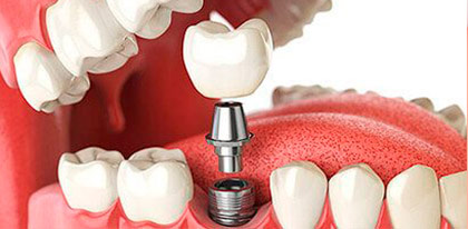 cirugiaeimplantes