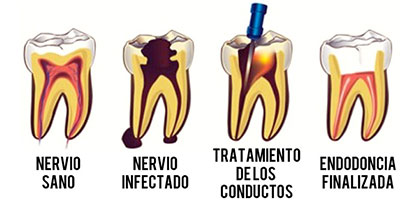 endodoncia-a