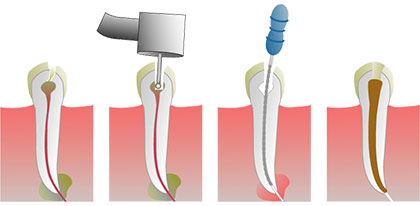 endodoncia-b