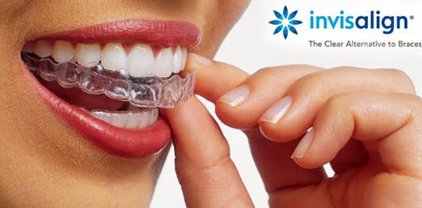 invisalign