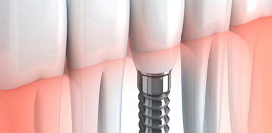 cirugia-e-implantes