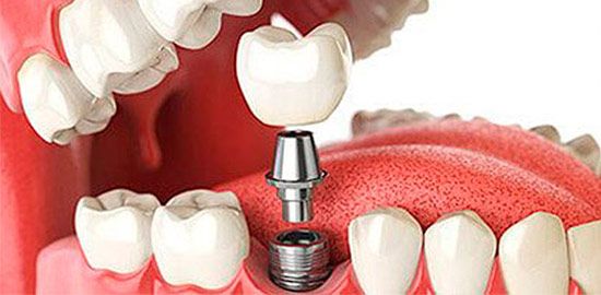 cirugiaeimplantes