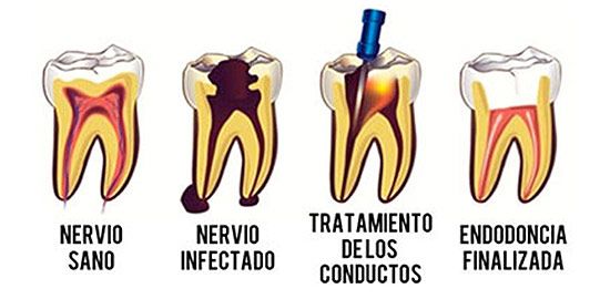 endodoncia_A
