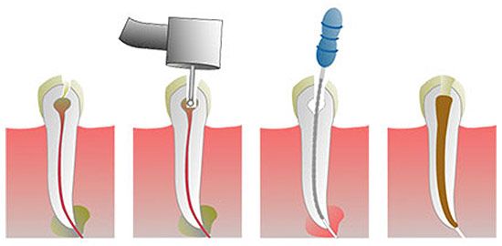 endodoncia_B